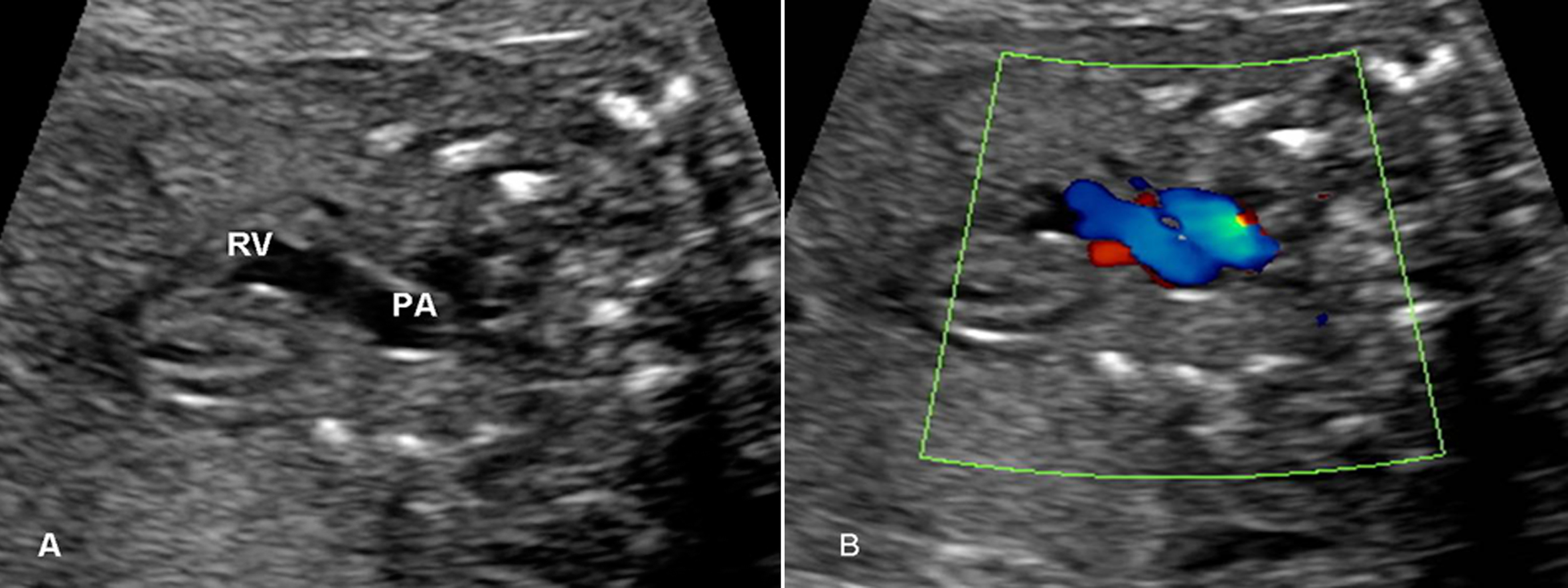 做普通的彩超能不能看到胎儿心脏,做彩超能知道胎儿准确多少周吗