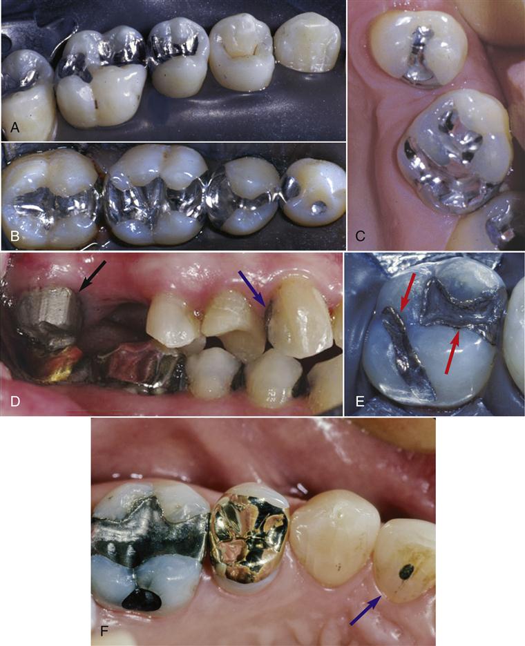 牙体缺损粘接修复术过程,口腔修复学牙体缺损的修复