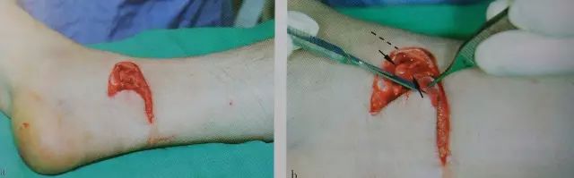 伤口闭合的正确方法,伤口清创的详细步骤