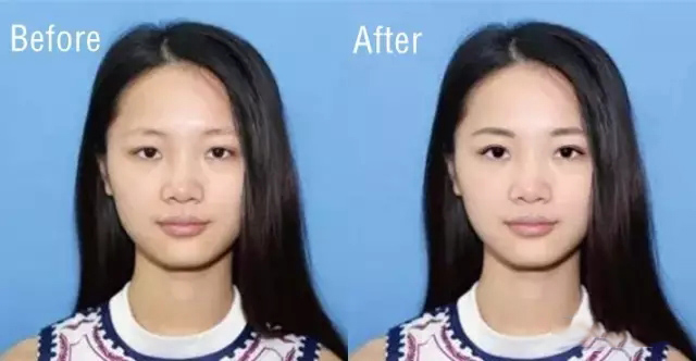 女生鼻子大鼻翼宽,鼻子大鼻翼宽怎么变好看