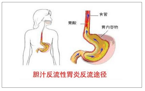 幽门失守，胆汁反流兴风作浪，医生：这种病想治好需改善生活习惯