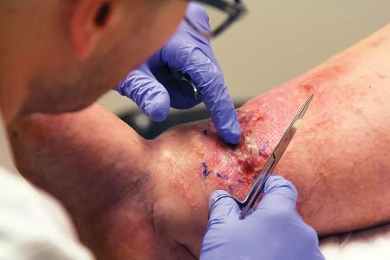 长蛆植入！连抗生素都搞不定的伤口，苍蝇宝宝竟能轻松搞定