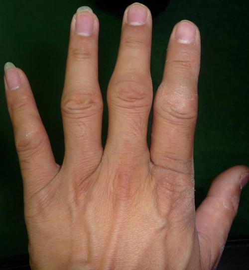 关于风湿病你了解多少,带您了解风湿病