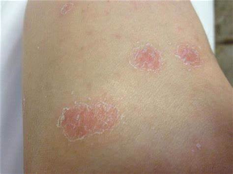 强直性脊柱炎会引起眼结膜充血,强直性脊柱炎眼炎属于什么阶段