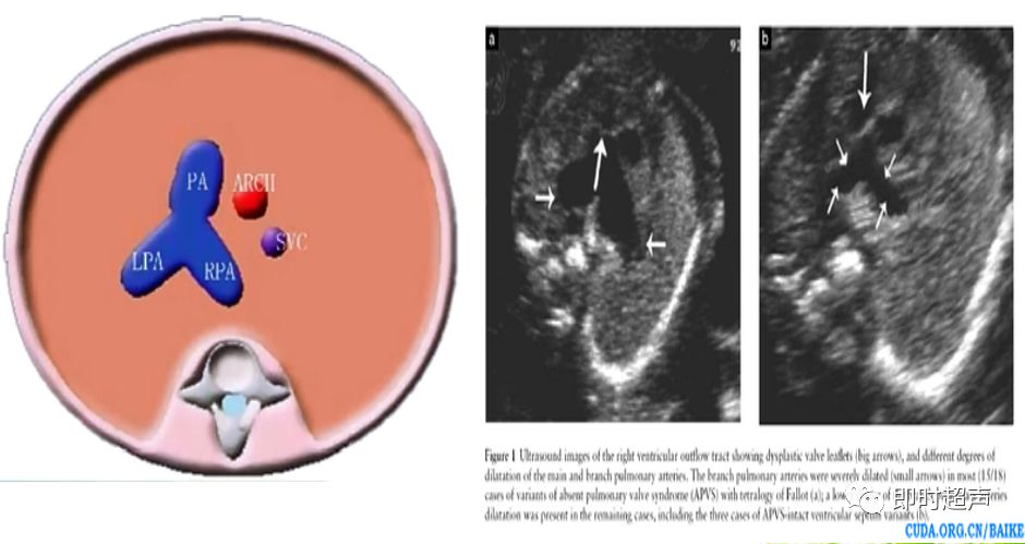 胎儿心脏三种血管关系模式图,25周的胎儿心脏弓切面多少正常