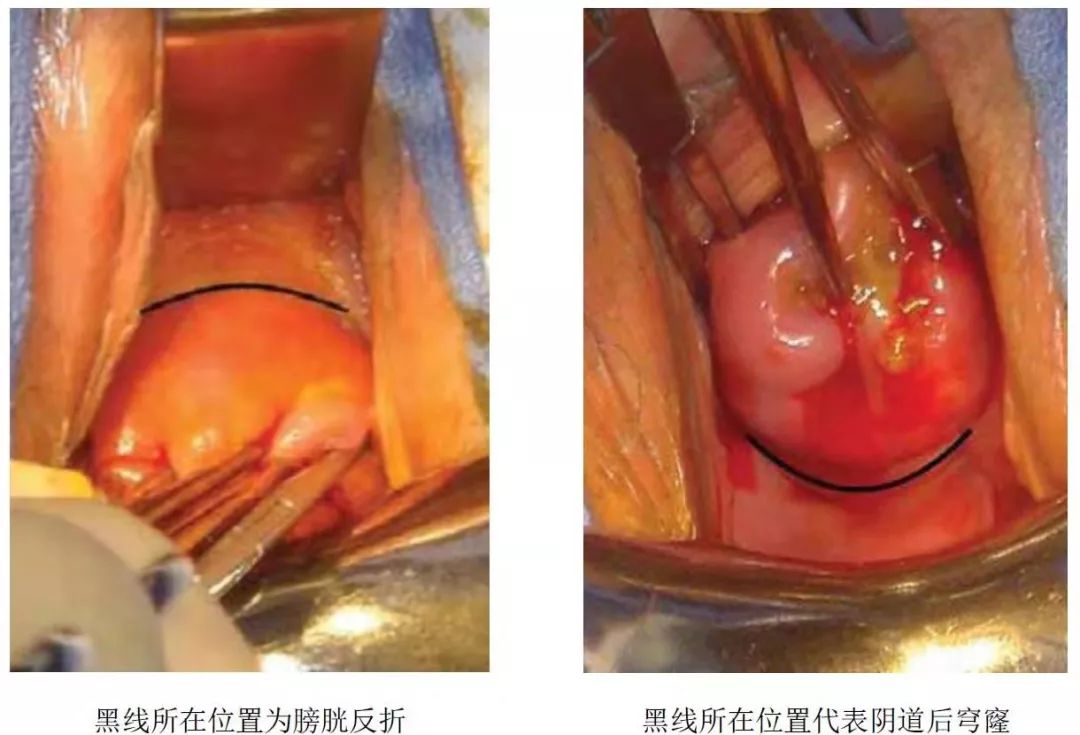 孕21周做宫颈环扎术成功率有多少,孕前腹腔镜宫颈环扎术过程及弊端