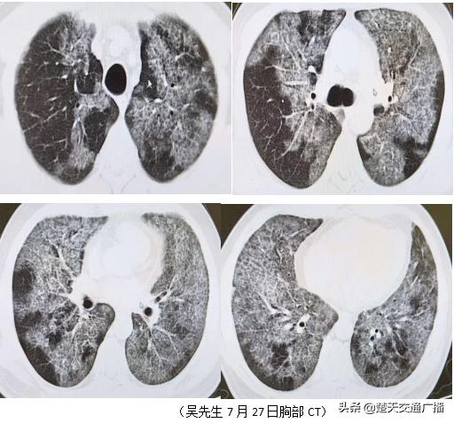 胸闷气喘半年,男子肺里洗出19升“牛奶”