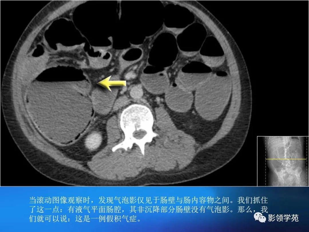 肠道内壁增厚,肠道扩张ct表现
