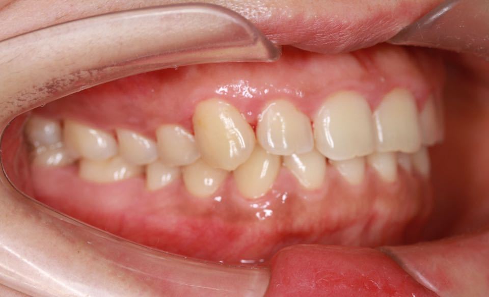 西安张军正畸医生如何,西安牙齿矫正案例