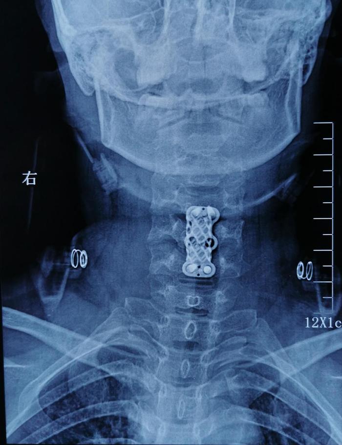 因颈背部疼痛、上臂抽疼，检查出颈5椎体结核