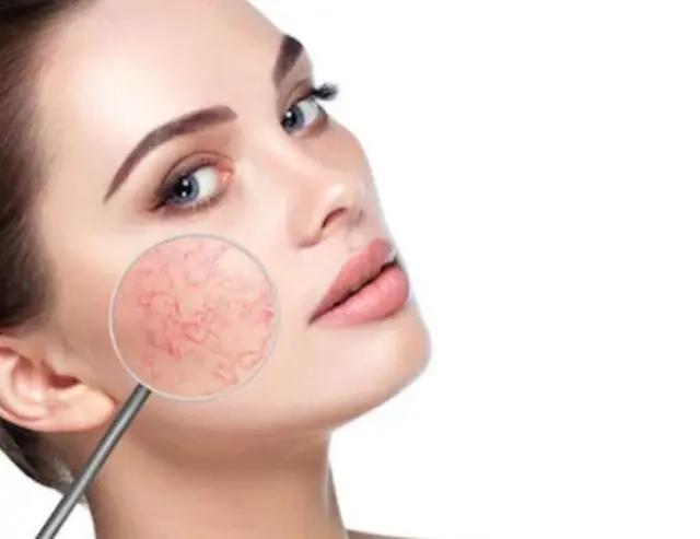 怎样修复敏感肌脸部突然发红,脸部发红敏感肌怎么治疗