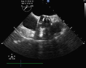 对造影剂过敏如何进行介入治疗,造影剂过敏迟发性治疗
