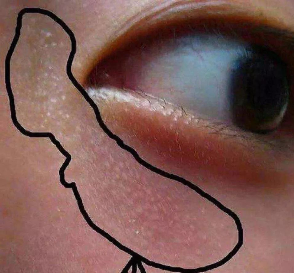 眼部脂肪粒有10多年了该怎么办,眼部脂肪粒不开刀四步解决