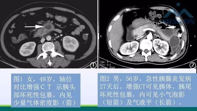 急性胰腺炎的护理措施,急性胰腺炎影像与临床
