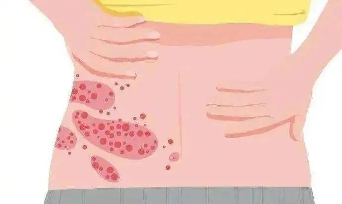 蔡依林、马思纯纷纷中招?痛如刀割的带状疱疹,真的致命吗?