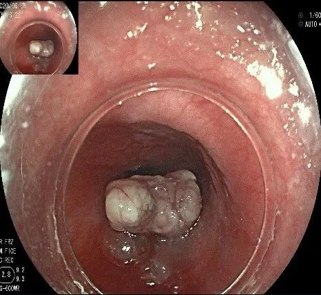 贲门处见隆起性病变,贲门高级别瘤变esd术后不能吃什么