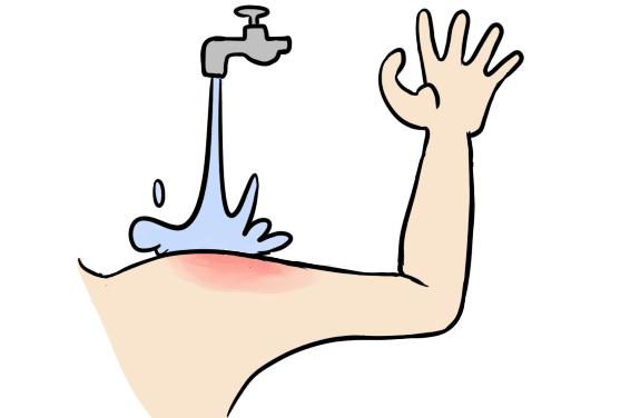 严重开水烫伤脱皮擦什么药最好,开水烫伤和烧伤哪个严重