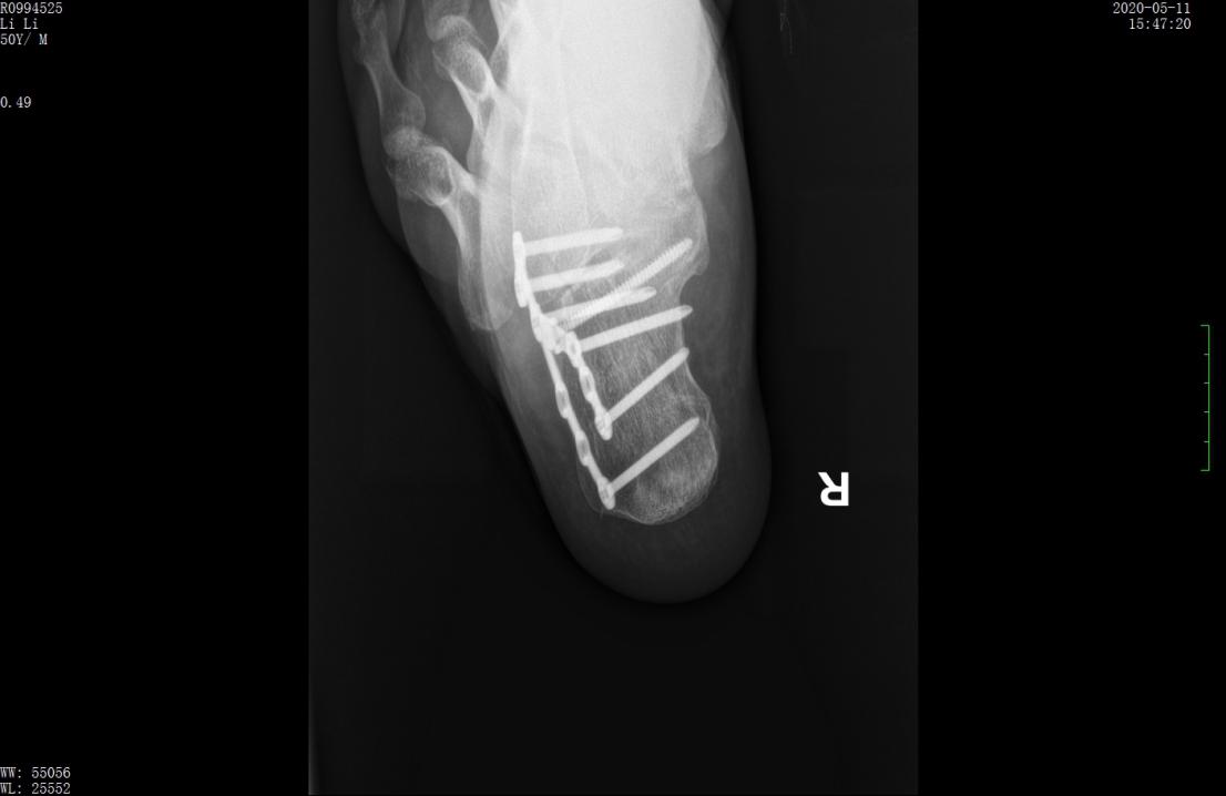 左股骨粗隆间粉碎性骨折微创手术,跟骨粉碎性骨折微创手术最快多久