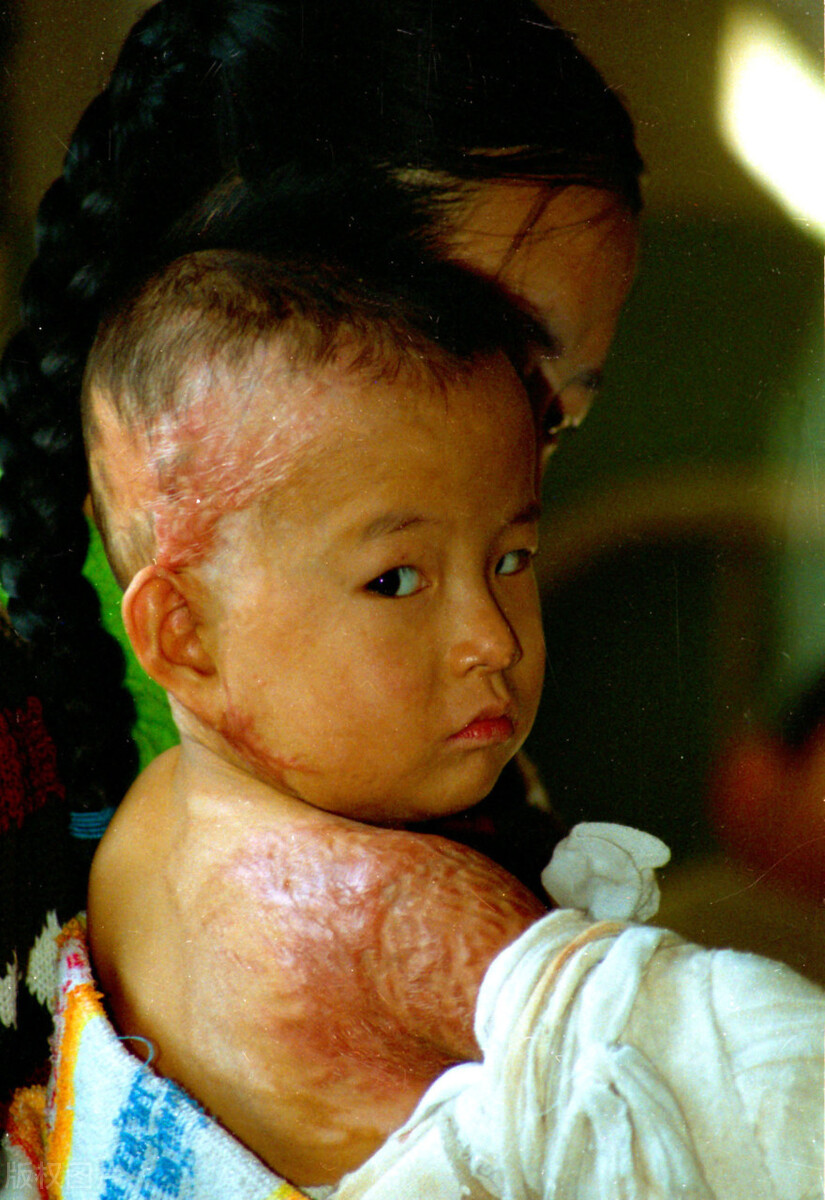 涂牙膏、抹猪油、敷蛋清、铺面粉？你真的知道怎样处理烧烫伤吗？