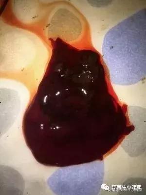 药流大出血女孩,大学生药流大出血