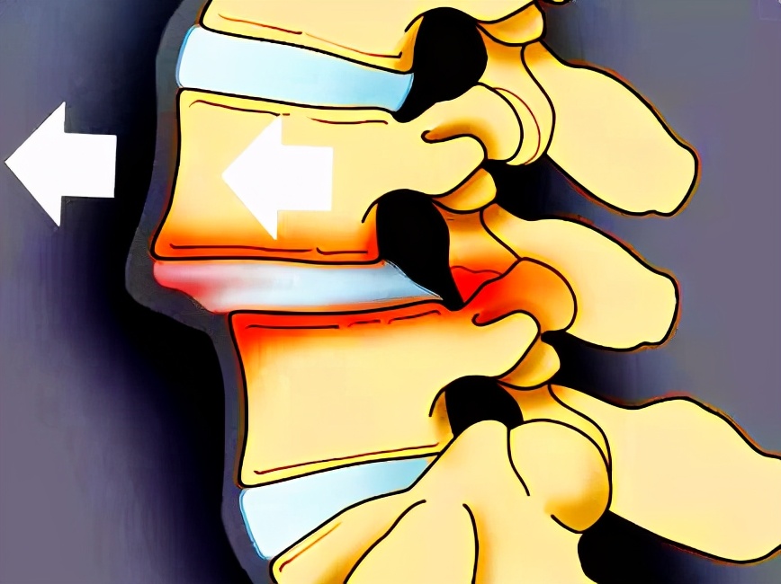 腰椎退行性变诊断书怎么写,腰椎退行性滑脱最好的治疗方法