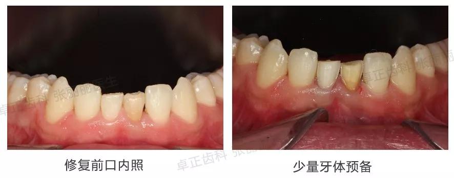 牙齿楔状缺损修复图片,牙齿楔状缺损修复大概多少钱