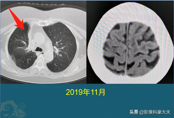 22岁查出癌症放弃治疗,医生自述得癌症放弃治疗
