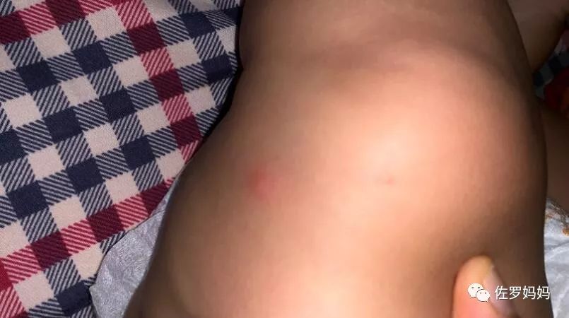 宝宝起疹子妈妈需要忌口吗,宝宝起湿疹妈妈着急