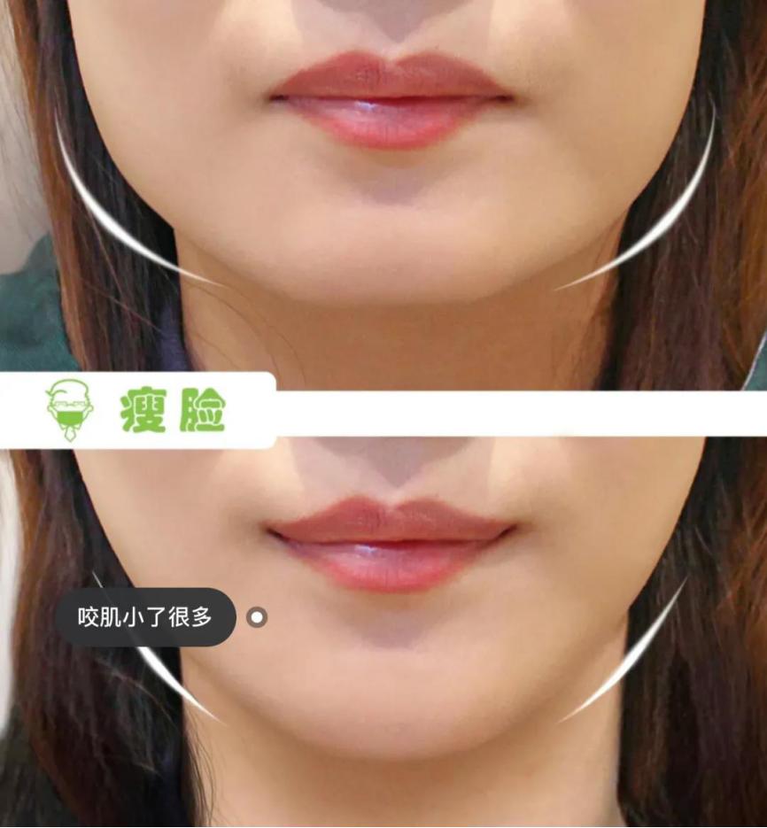 科普瘦脸针避雷,为什么打完瘦脸没有一点酸胀感