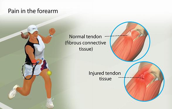 网球肘是否常见肘前外侧痛,网球肘能引肘关节和肩关节疼痛吗