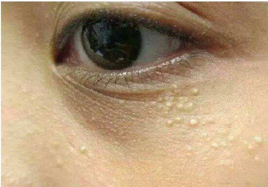 去眼部脂肪粒的最好方法,祛眼部脂肪粒最有效的方法