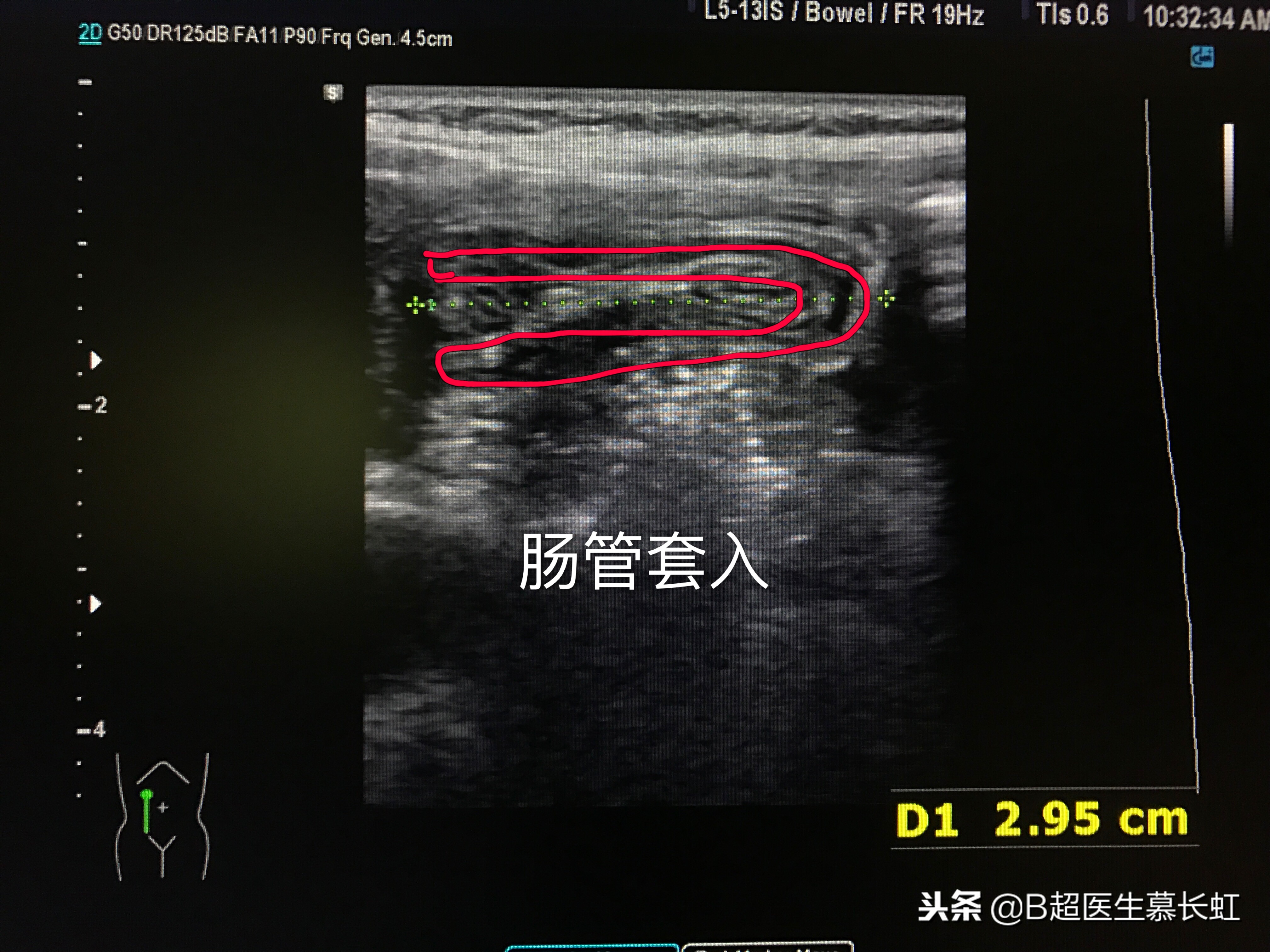 儿童肚子疼呕吐拉血怎么回事,2岁宝宝说肚子痛肠套叠