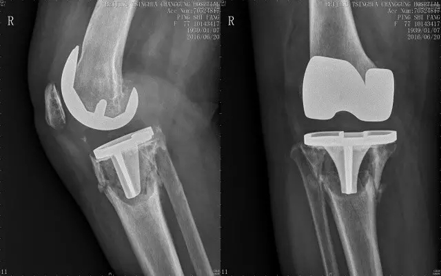 老年人关节病想置换人工关节，又担心副作用，该怎么办？