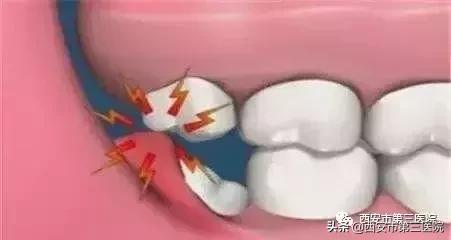 拔智齿不拔牙根会怎么样,拔下面智齿上面不拔可以吗