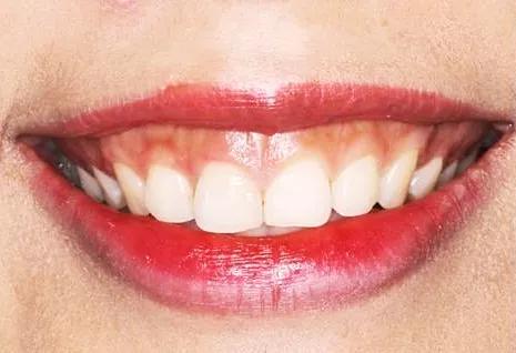 牙缝又大又难看还显老,牙缝大怎么修图