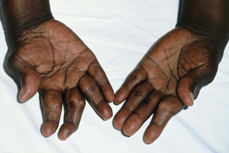 类风湿急性发作期怎么处理,类风湿发作时中医怎么治