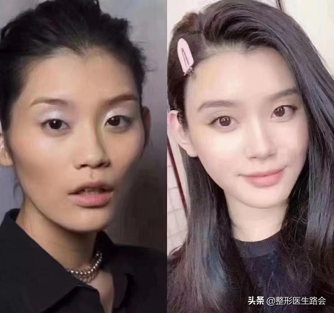 太阳穴凹陷颧骨高适合留中分吗,太阳穴凹颧骨高用什么哑光高光好