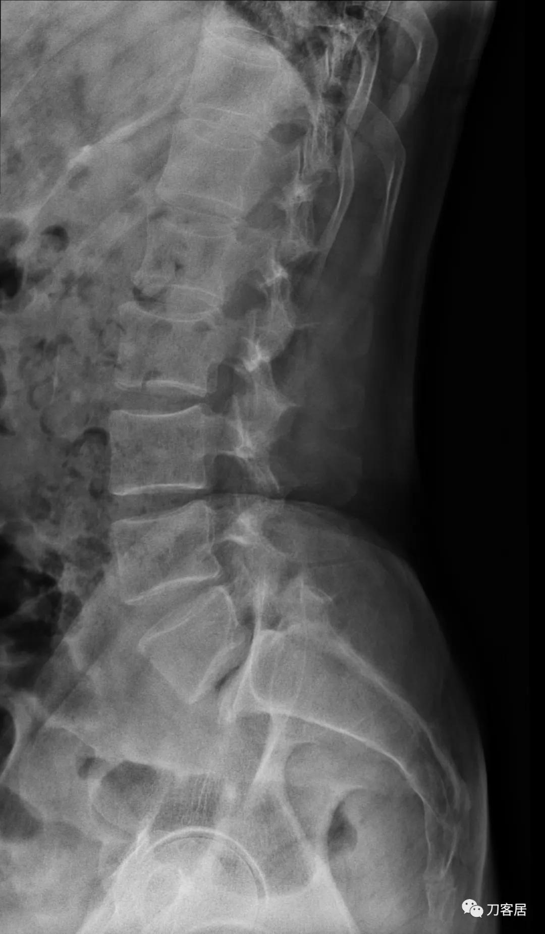 小针刀扎到坐骨神经会瘫痪吗,小针刀会切断坐骨神经吗