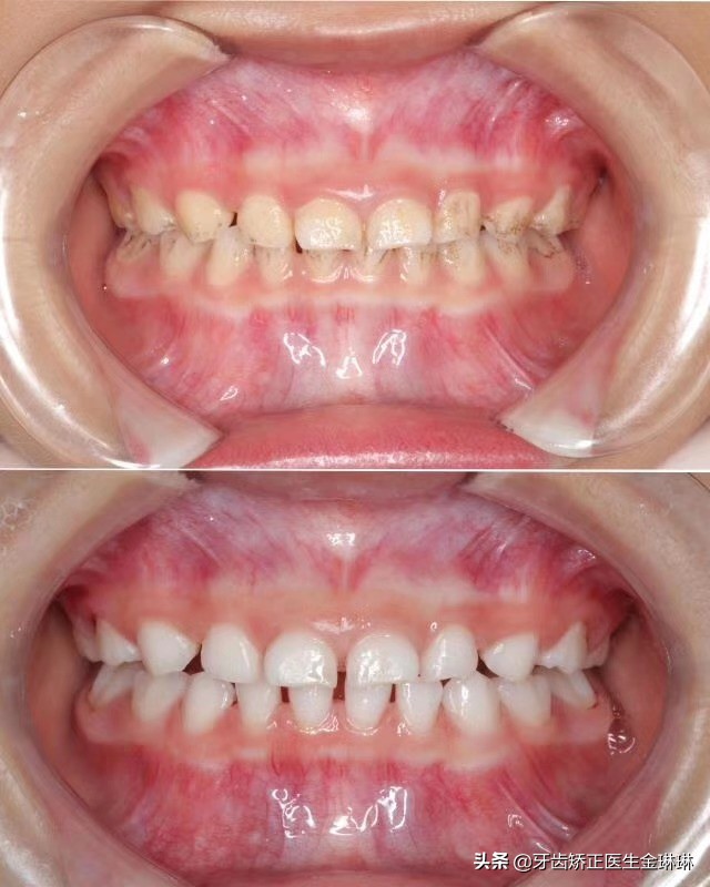 宝宝牙齿上有黑色的污垢怎么去除,婴儿牙齿有污垢怎么清理