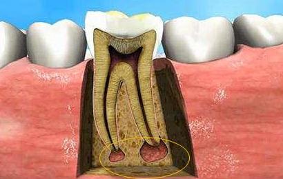 五岁小孩牙齿蛀了需要补吗,门牙边上的牙齿蛀了能补吗
