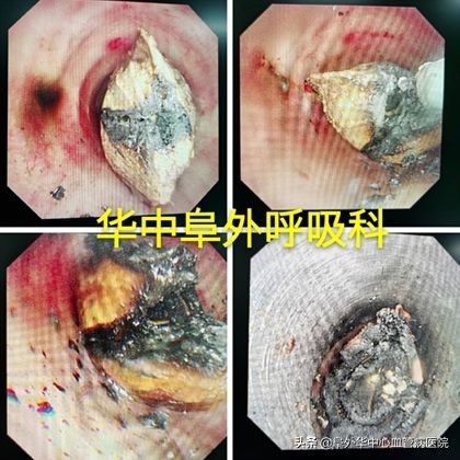 八旬老人误吞枣核肠,老人误吞枣核怎么化解