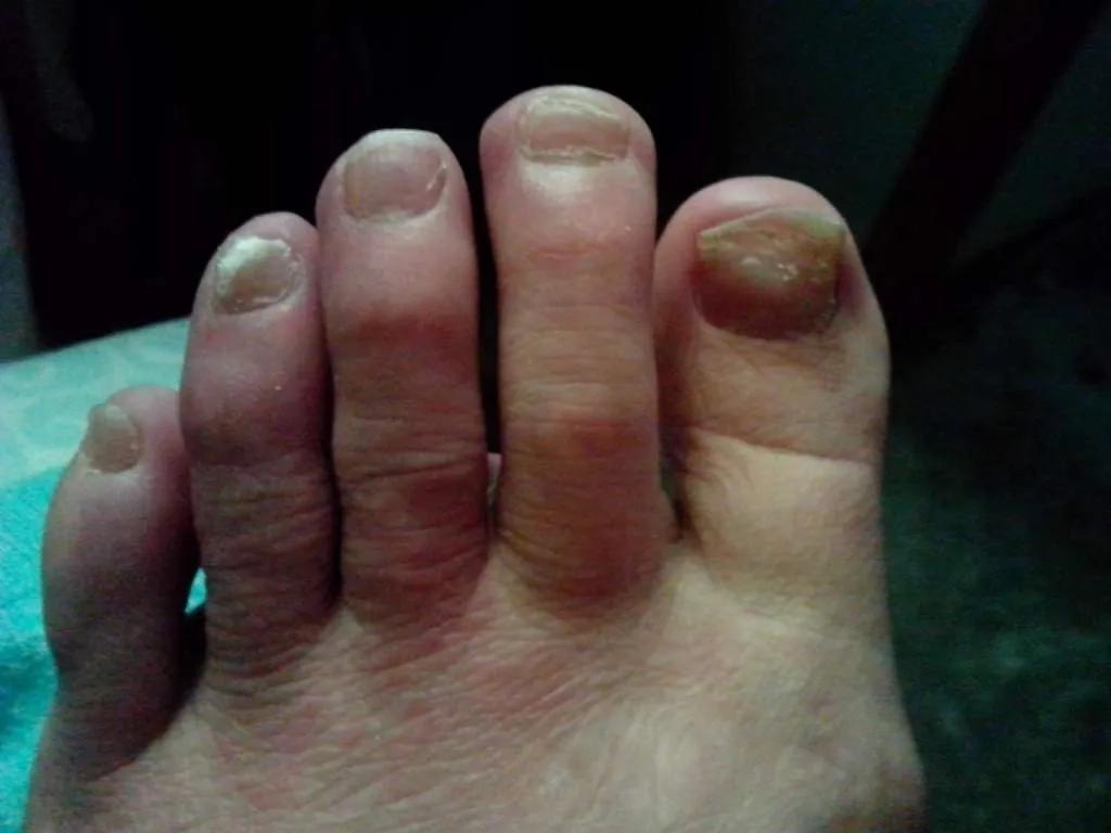 专家教你正确剪指甲的方式,正常指甲怎么修剪为健康