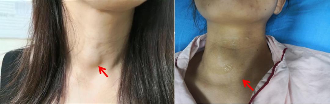 甲状腺结节微创消融手术,甲状腺结节微创消融医保