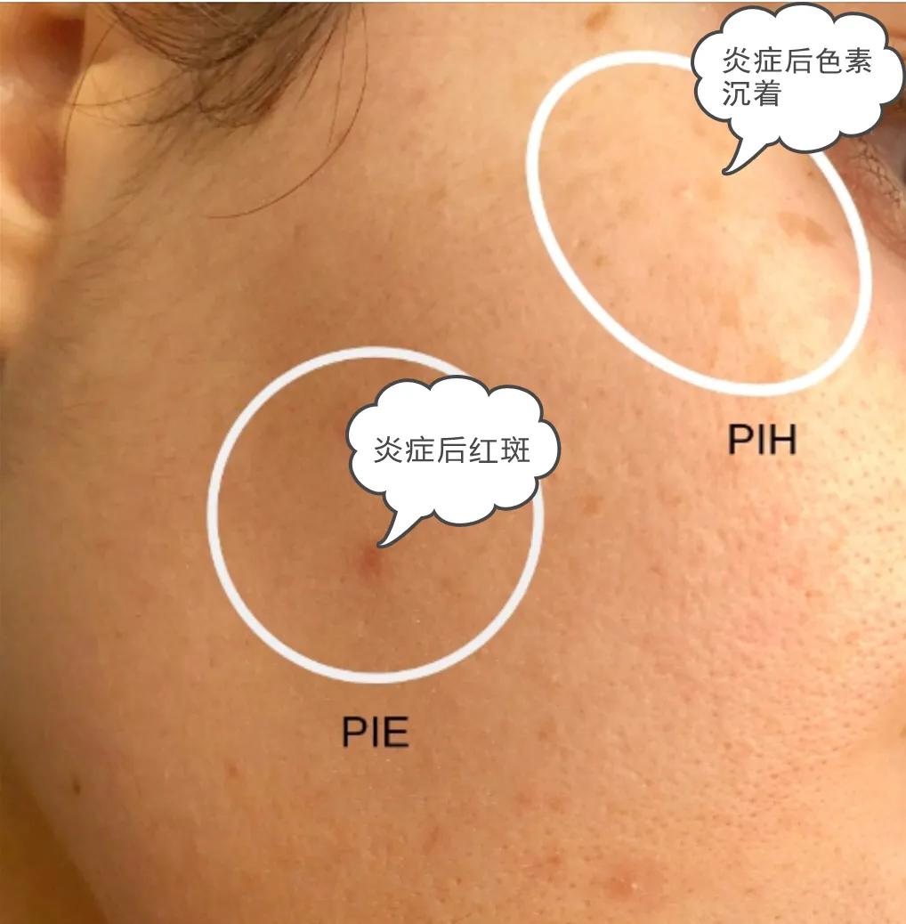 疮好后有红色疤痕怎么消除,长疮留下的黑色素沉着怎么去掉
