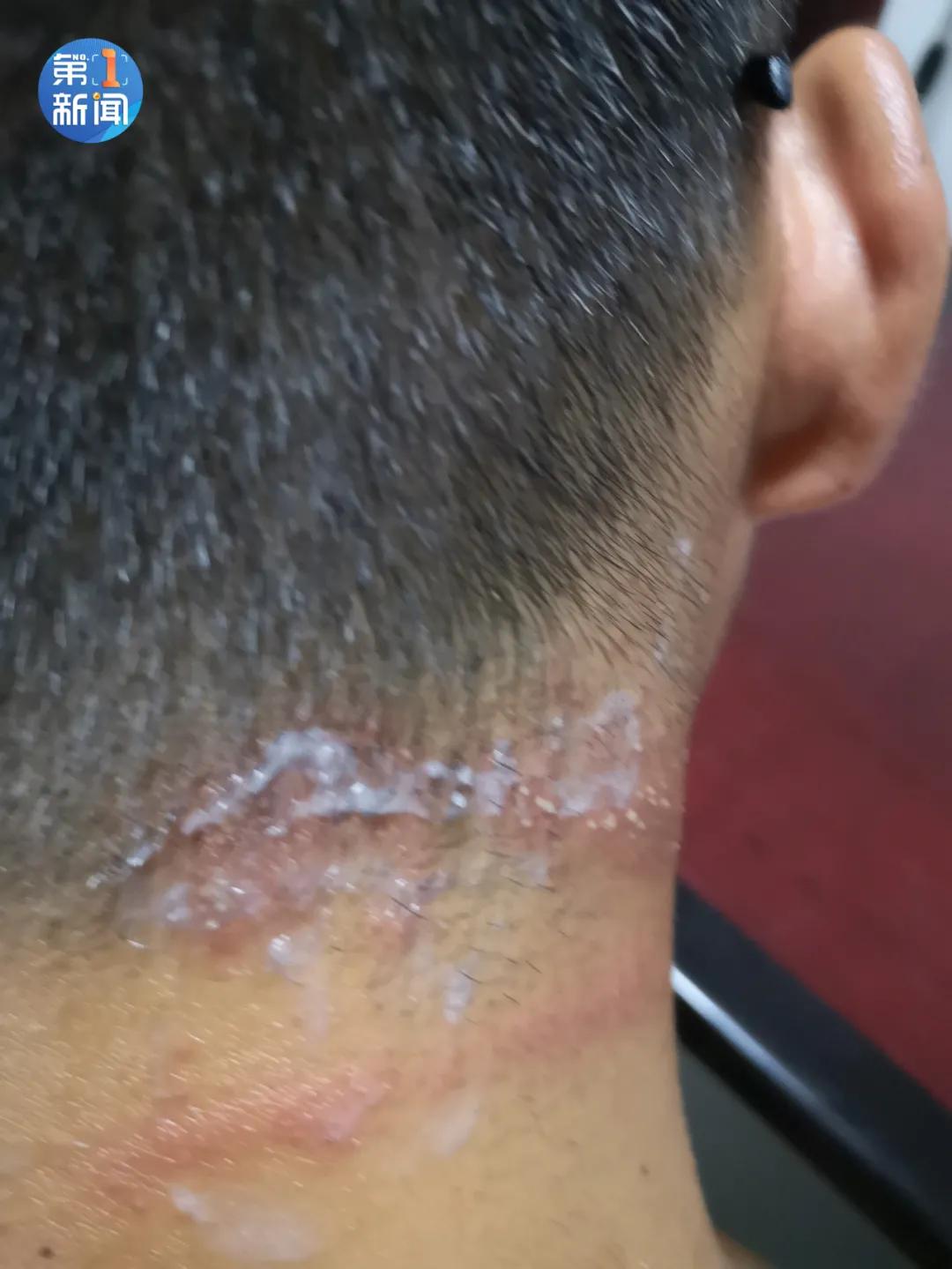 男孩户外拍死一只虫子,小伙拍死一只虫子后果不堪设想