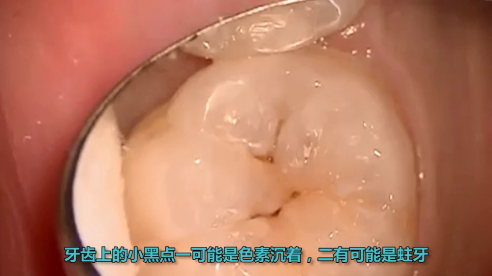 牙齿表面有小黑点内部一定坏了吗,根管治疗后牙齿有小黑点