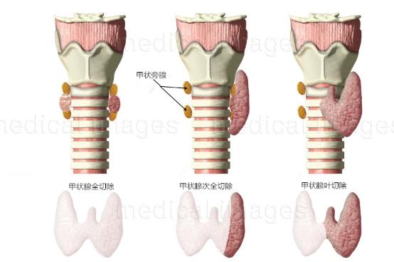 甲状腺功能亢进症的科普文章,甲状腺功能亢进症适宜的治疗方法