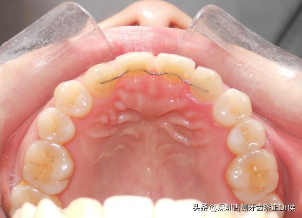 保持器怎么做微调,保持器该怎么选