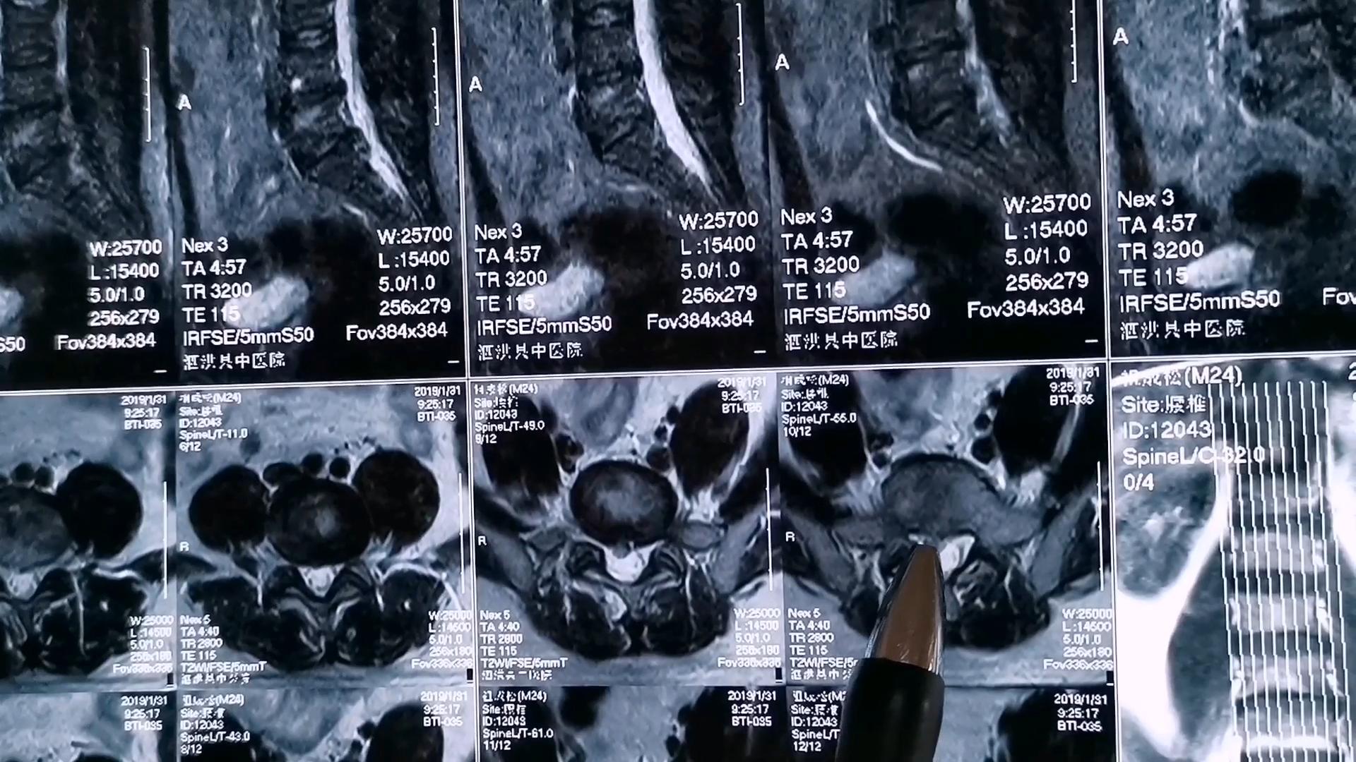 针灸治疗腰突症病例分享,针灸治疗腰突腿痛一般几天有效果