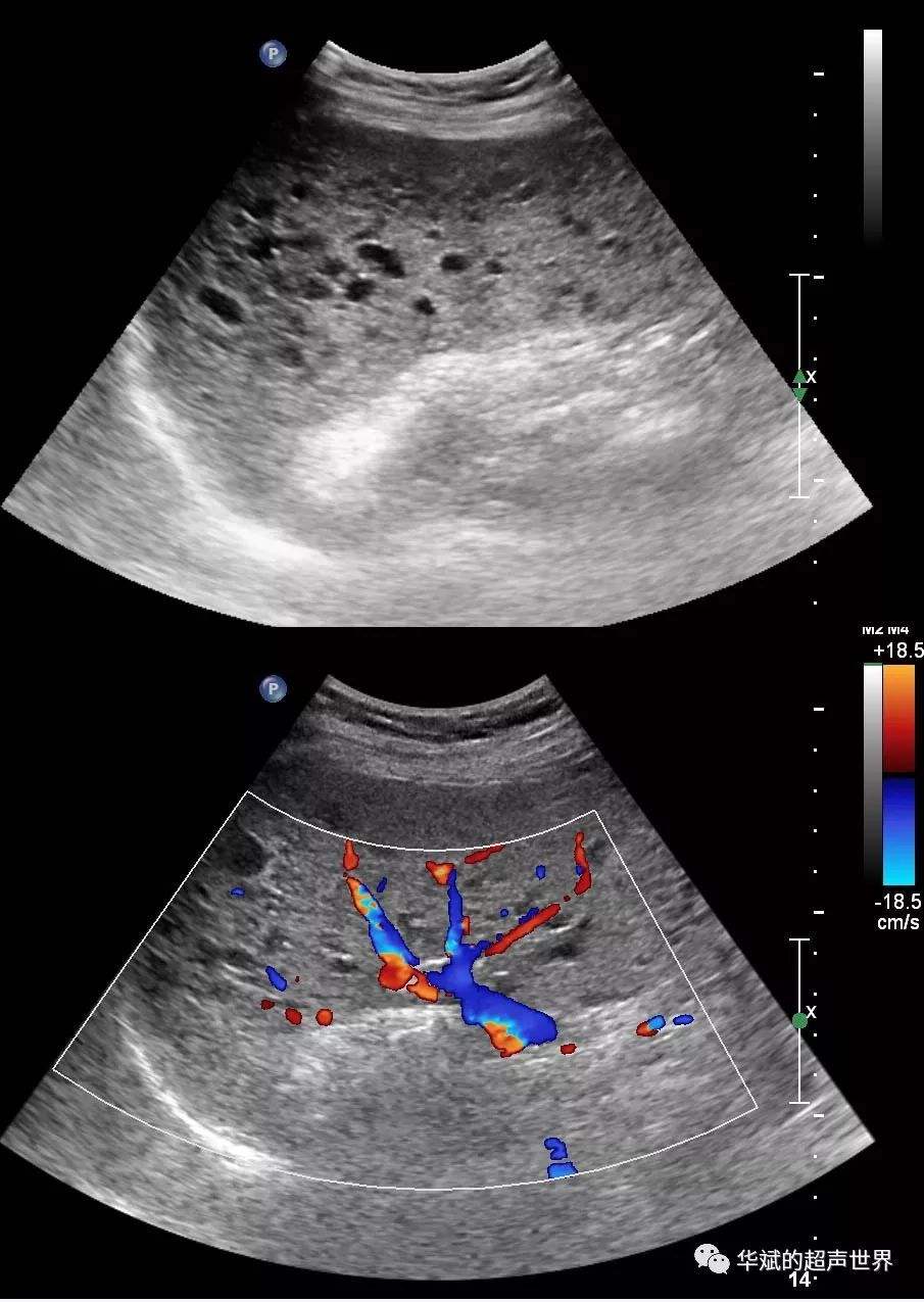 脾大一般什么原因,脾大的原因及调理方法
